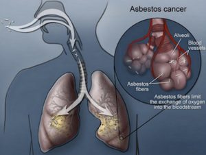 causes-of-asbestos-lung-cancer